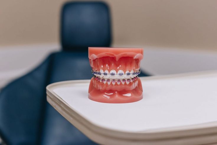 Niềng Răng Hô Bao Nhiêu Tiền